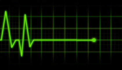 ECG Electrocardiogram
