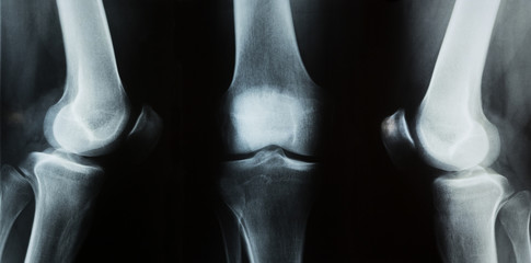 x-ray photo of a human knee - obrazy, fototapety, plakaty