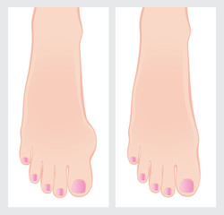 Bunion before and after operation