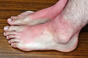 Sunburn on the feet