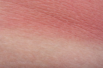 Fototapeta premium Example sunburn