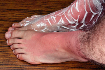 Sunburn legs