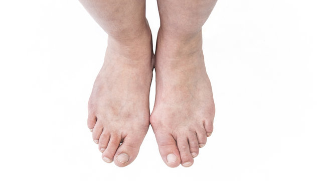 Hallux valgus