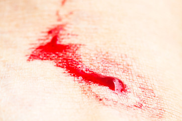 Wounds caused by the bite of blood-sucking leeches.