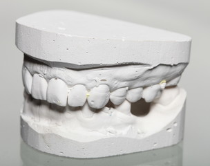 Dental gypsum model mould of teeth in plaster