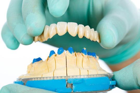 Porcelain Teeth - Dental Bridge