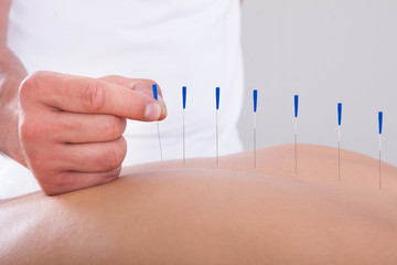 Woman Receiving An Acupuncture Therapy - obrazy, fototapety, plakaty