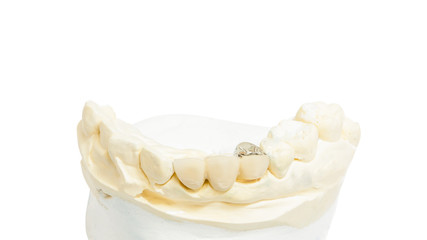 Dental prosthesis on white background