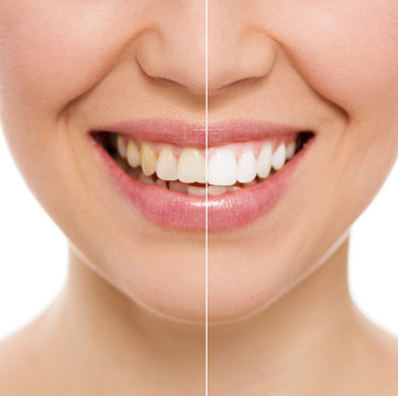 Before and after bleaching or whitening treatment, isolated
