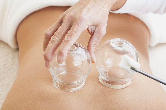 Close up of female therapist treating teenager patient with Chinese cupping acupuncture