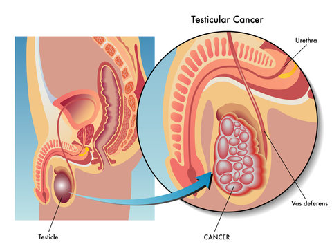 cancro del testicolo