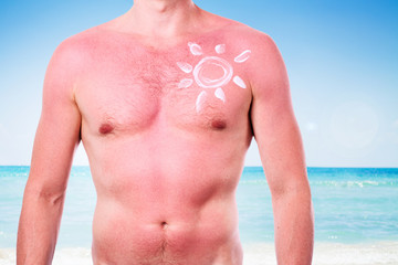 Man with a sunburn
