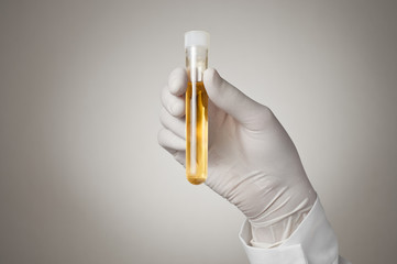 Doctor's hand with urine sample