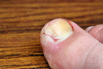 Toe after surgery