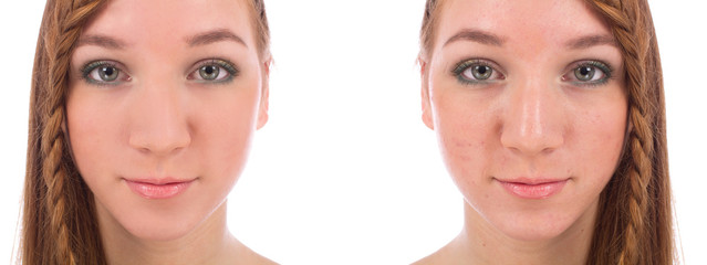 Close-up of teenager face with and without acne