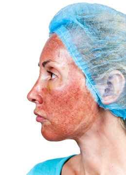 Cosmetology. Skin condition after chemical peeling TCA
