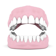 Dentures
