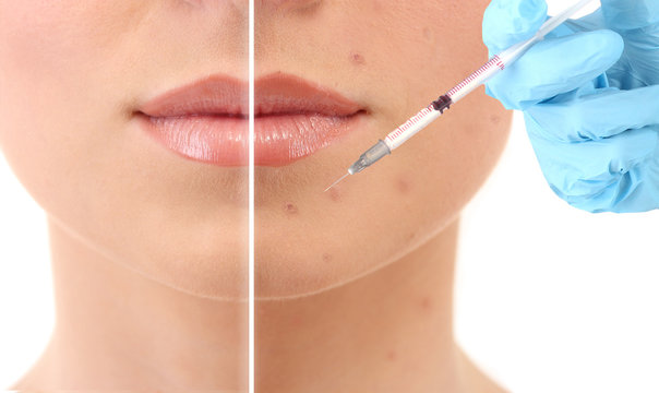 Woman's face before and after injection of acne isolated