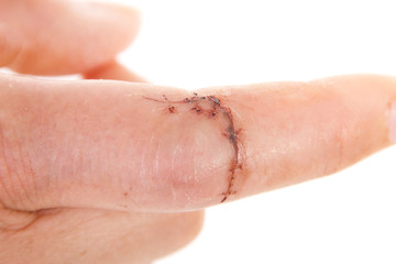Close-up of sewed wound on caucasian finger