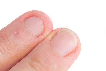 Fingernägelkauen