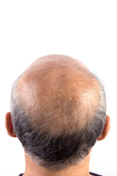 hair loss bald man