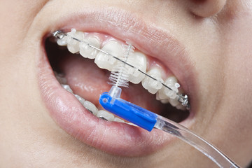 Brushing your teeth with braces