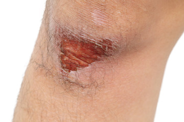 isolated wounded knee