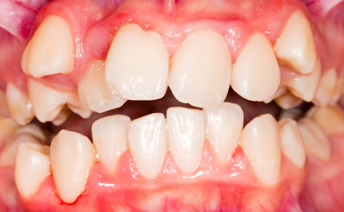 Dental displacement