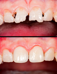 Before and after
