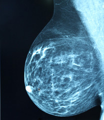 Mammogram radio imagingr breast cancer diagnosis