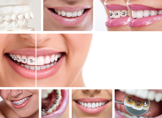 dental braces - obrazy, fototapety, plakaty