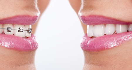 teeth with braces