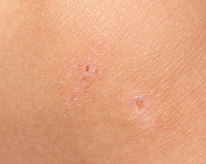 Fototapeta premium wound on the skin. macro