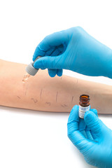 doing a skin prick allergy test