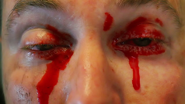 Bleeding from both eyes