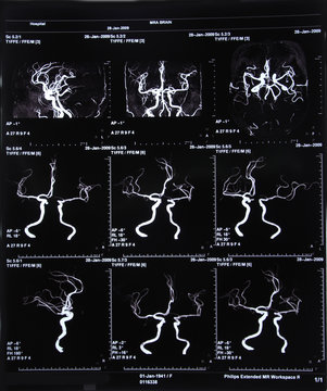 MRI scan image of brain