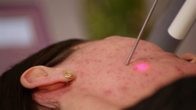 laser treatment, the removal of acne