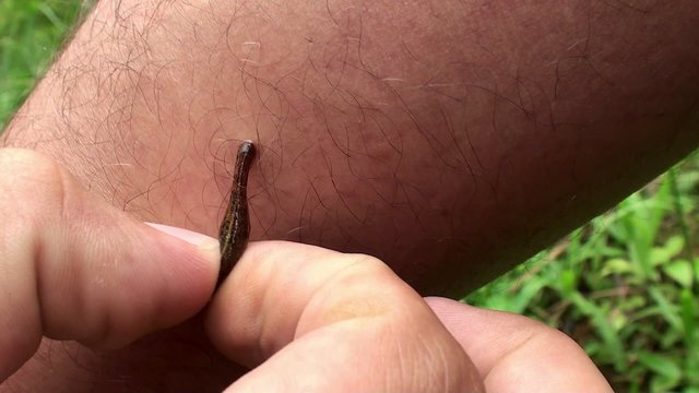 Removal by hand of Jawed Land leech with legs of a man