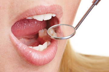 Frau mit offenem Mund und Zahnarztspiegel