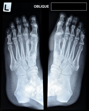an x-ray of mature man's feet.
