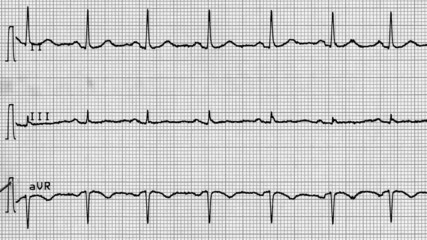 Electrocardiography of heart beat