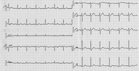 Electrocardiography of heart beat