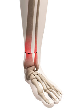 medical illustration of a broken leg bone