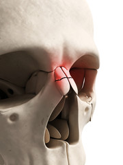 medical illustration of a broken nose