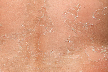 Part of peeling back