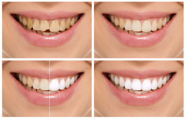 Teeth decay cure. Tooth whitening. Before and after. - 57342423