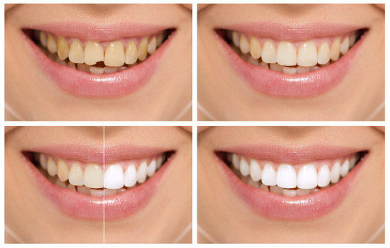 Teeth decay cure. Tooth whitening. Before and after.
