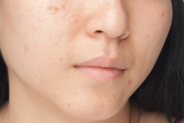 Acne spots and skin problem
