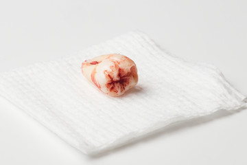 Blood covered extracted wisdom tooth on gauze