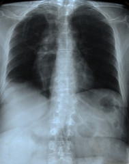 X-Ray Image Of Human Chest